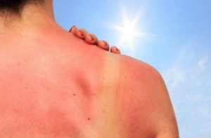 queimadura verão