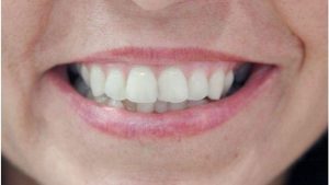 dentes desalinhados