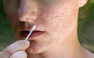 Dicas-EXCLUSIVAS-de-como-prevenir-cicatriz-de-acne-e-espinhas-1024x640